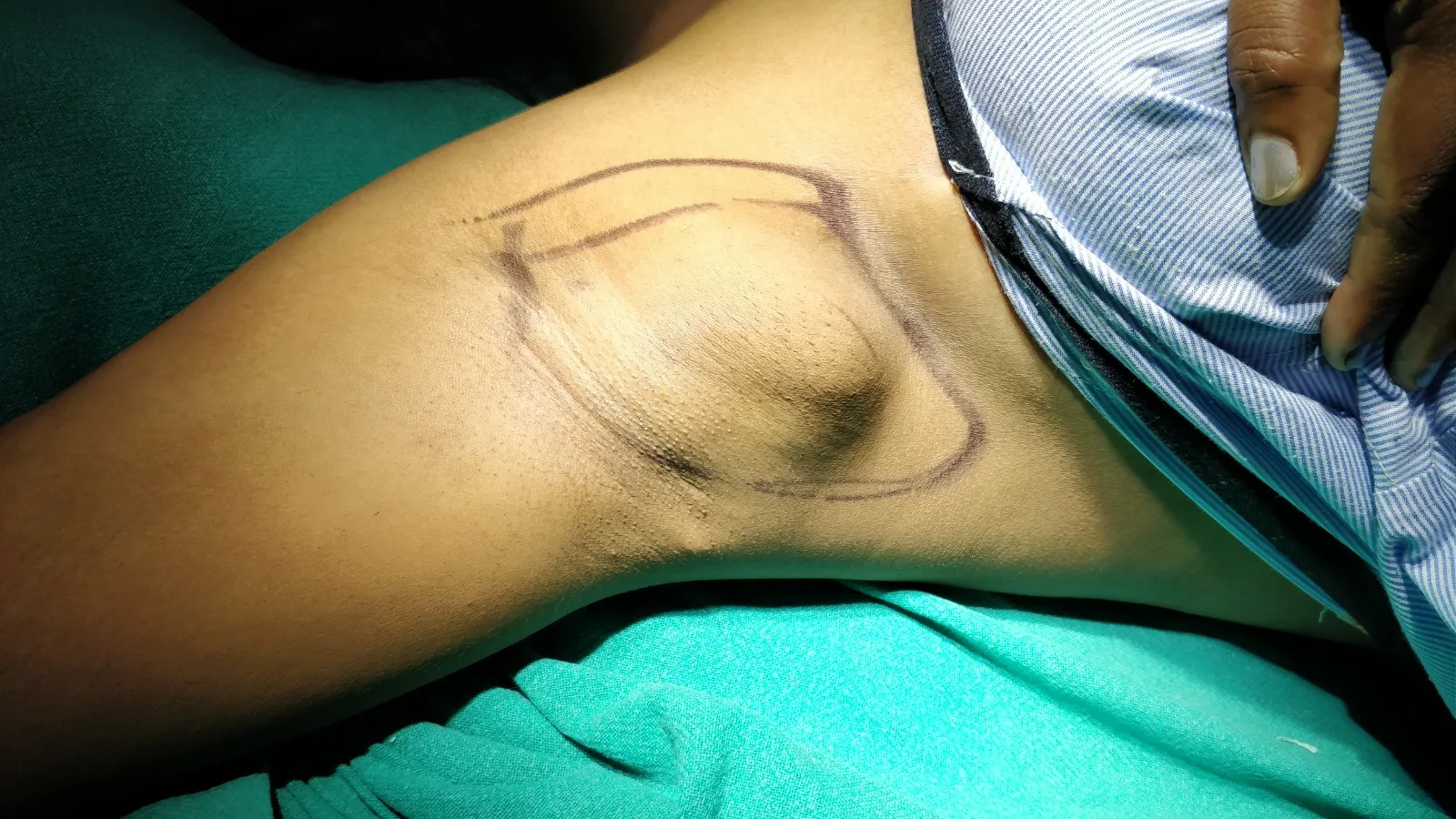 Axillary Breast Excision — Case 1