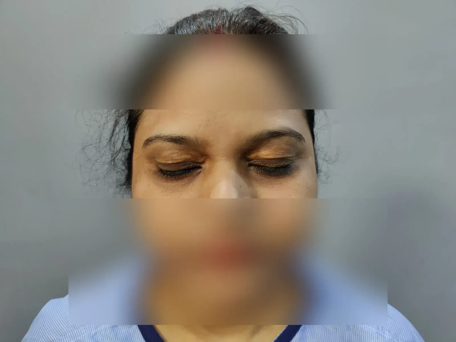 Blepharoplasty