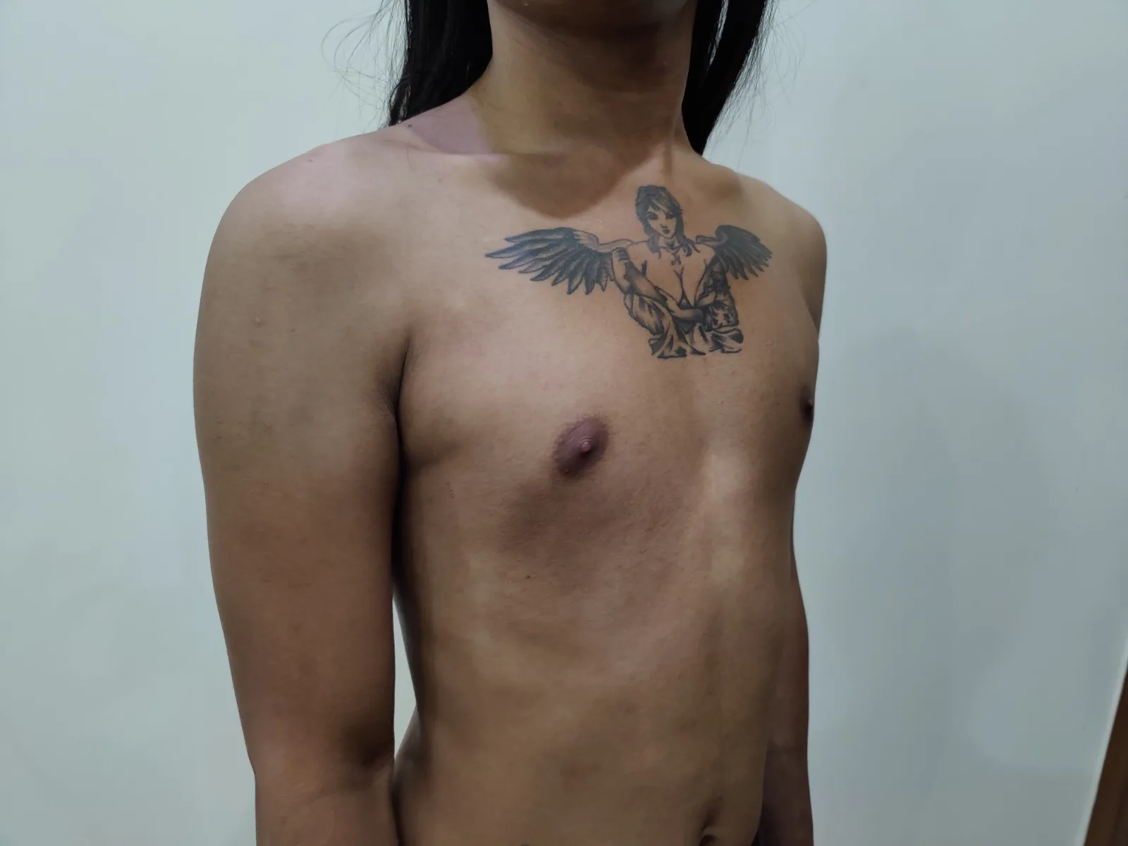 Breast Implants (MTF) — Case 1