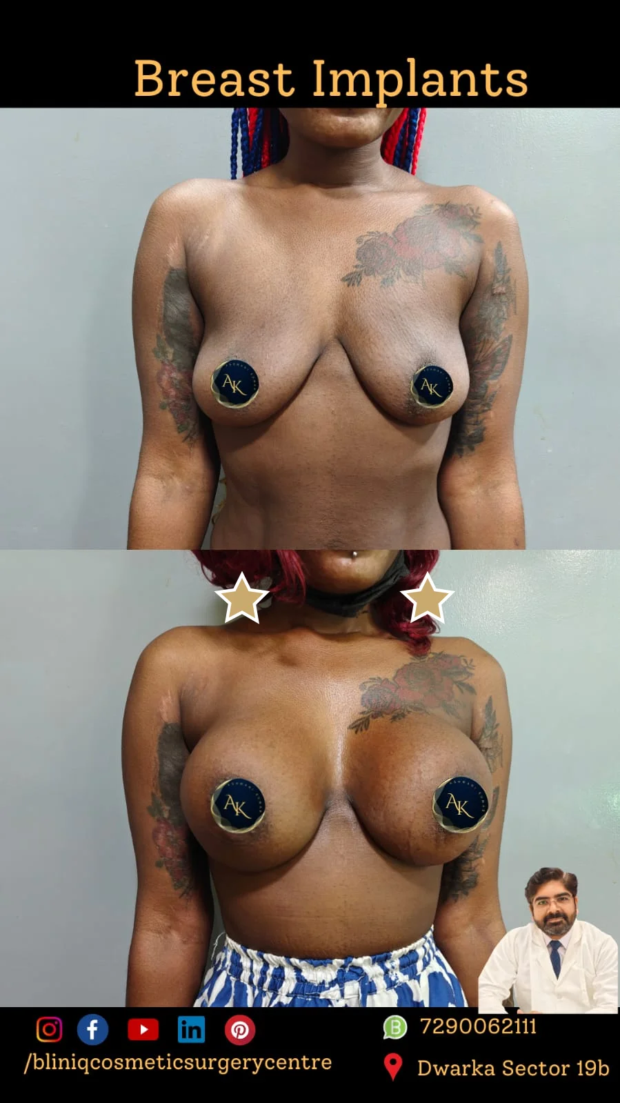 Breast Implants — Case 1