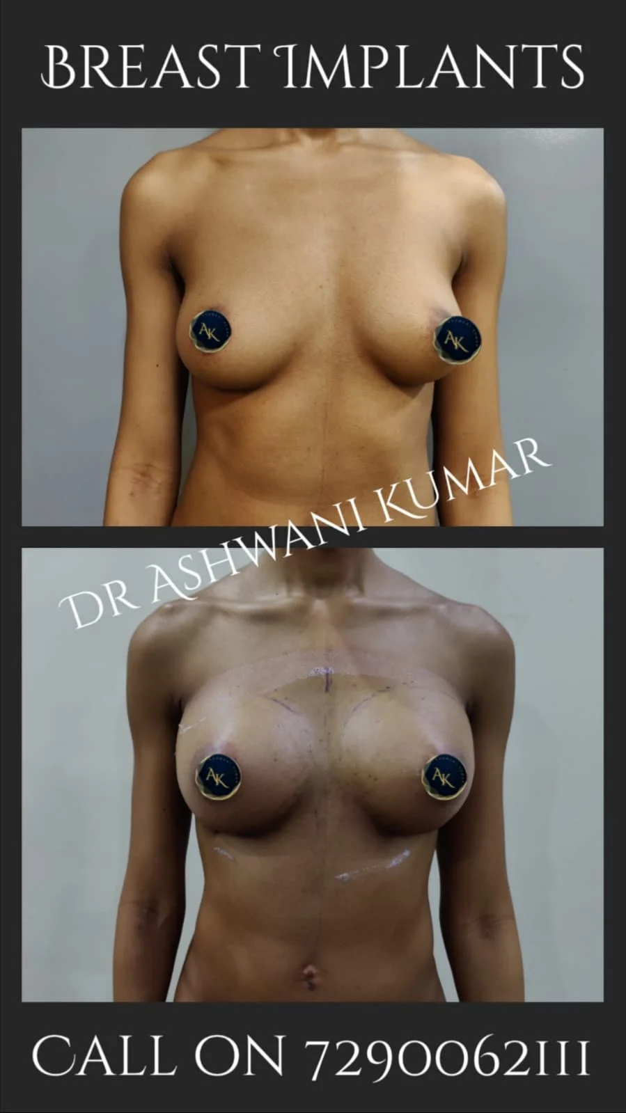 Breast Implants — Case 2