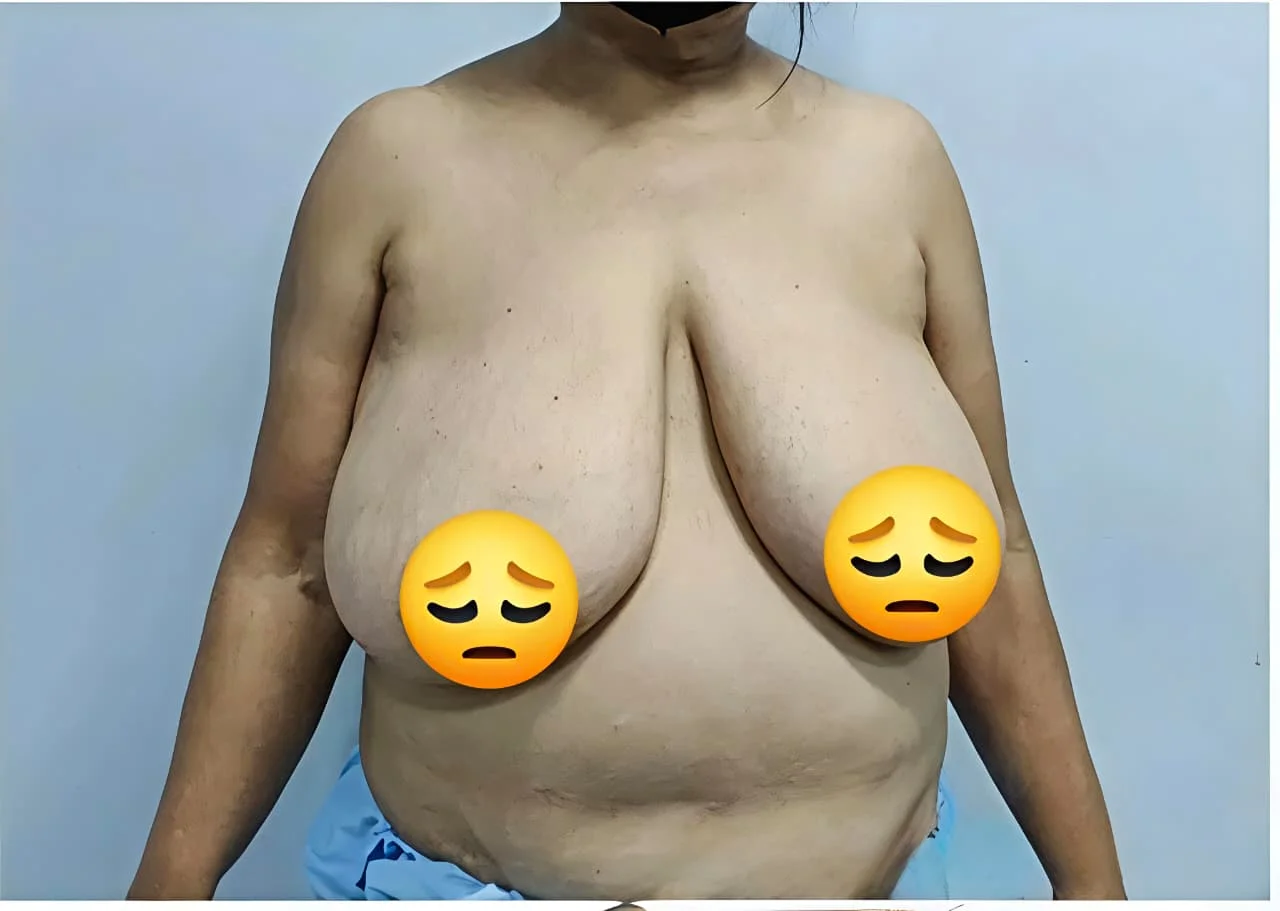 Breast Reduction — Case 1
