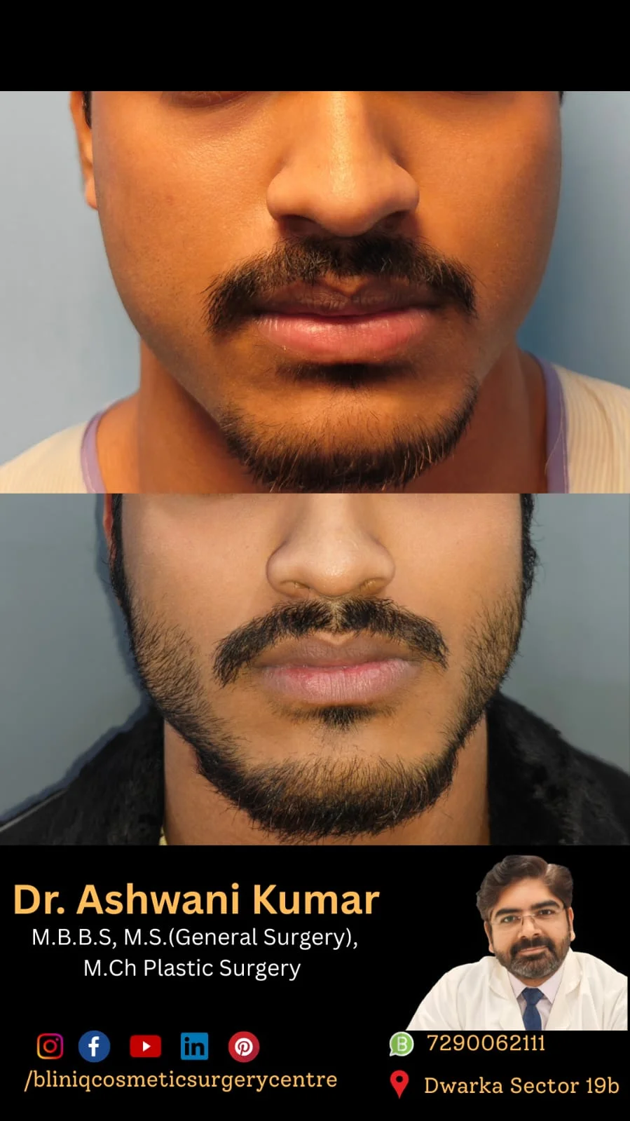 Buccal Fat Pad Removal