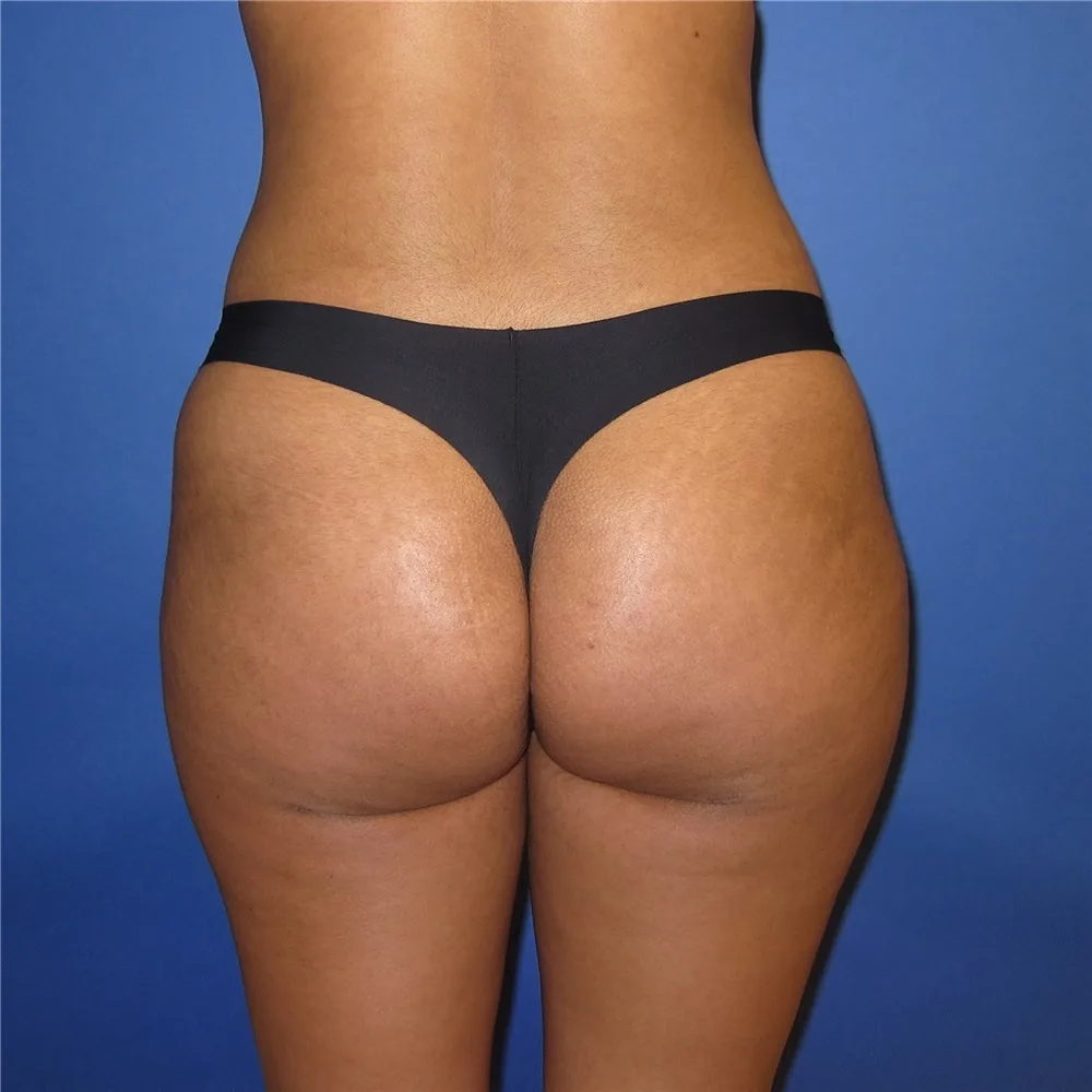 Butt Augmentation — Case 1