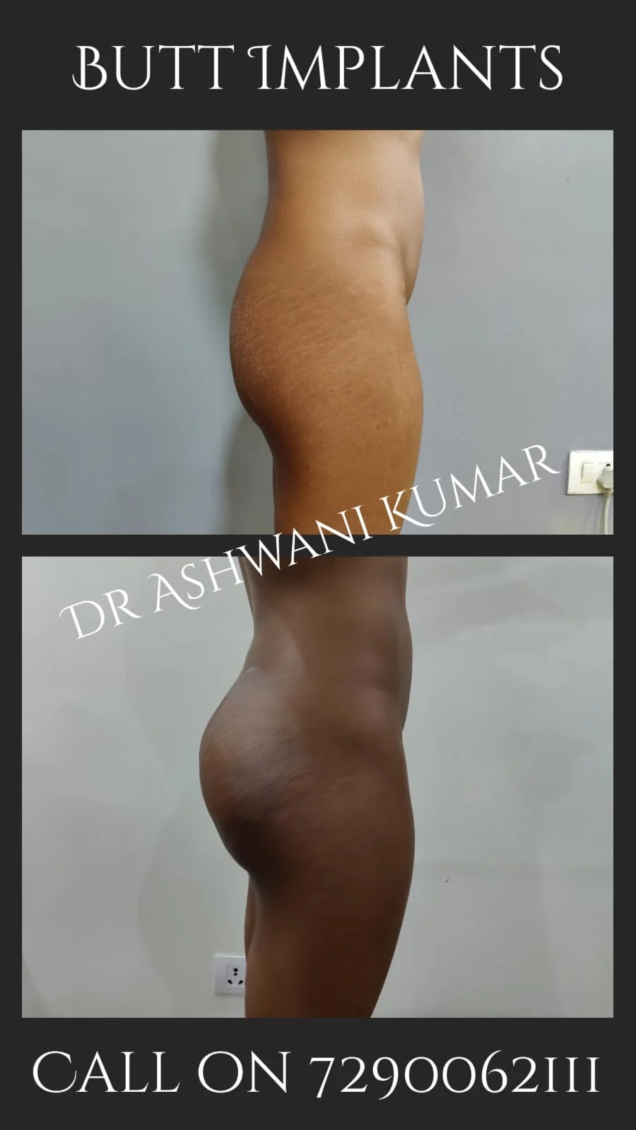 Butt Augmentation — Case 2