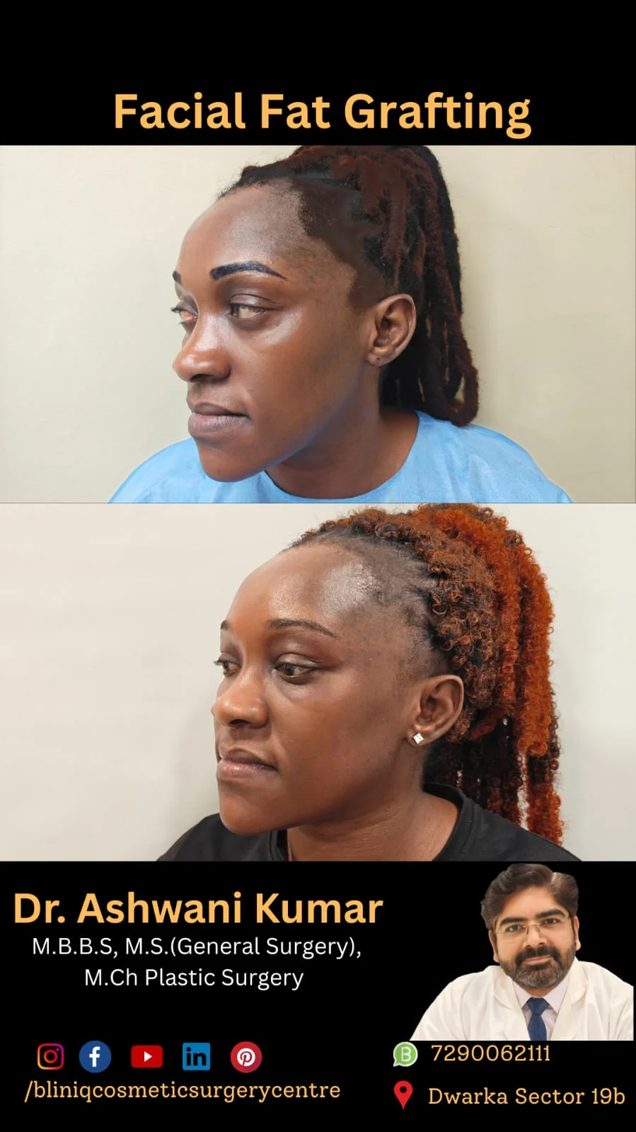 Facial Fat Injection — Case 1