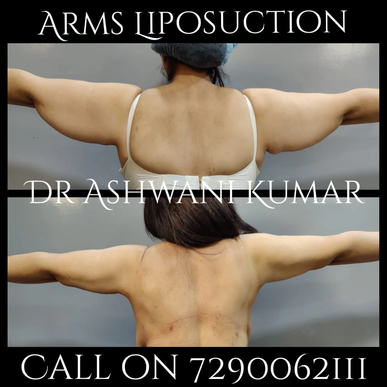 Arms Liposuction — Case 1