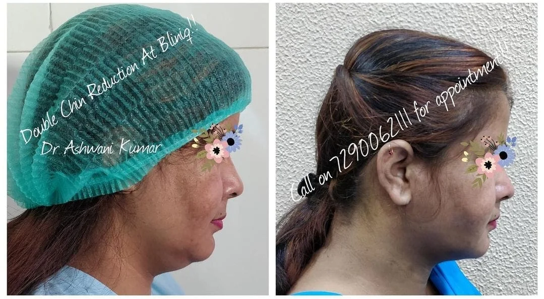 Double Chin Reduction — Case 2