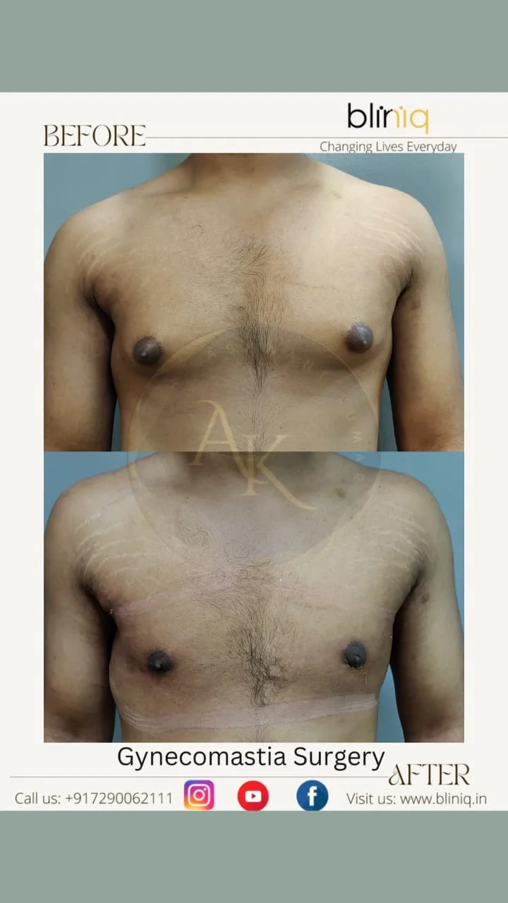 Gynecomastia Correction — Case 4