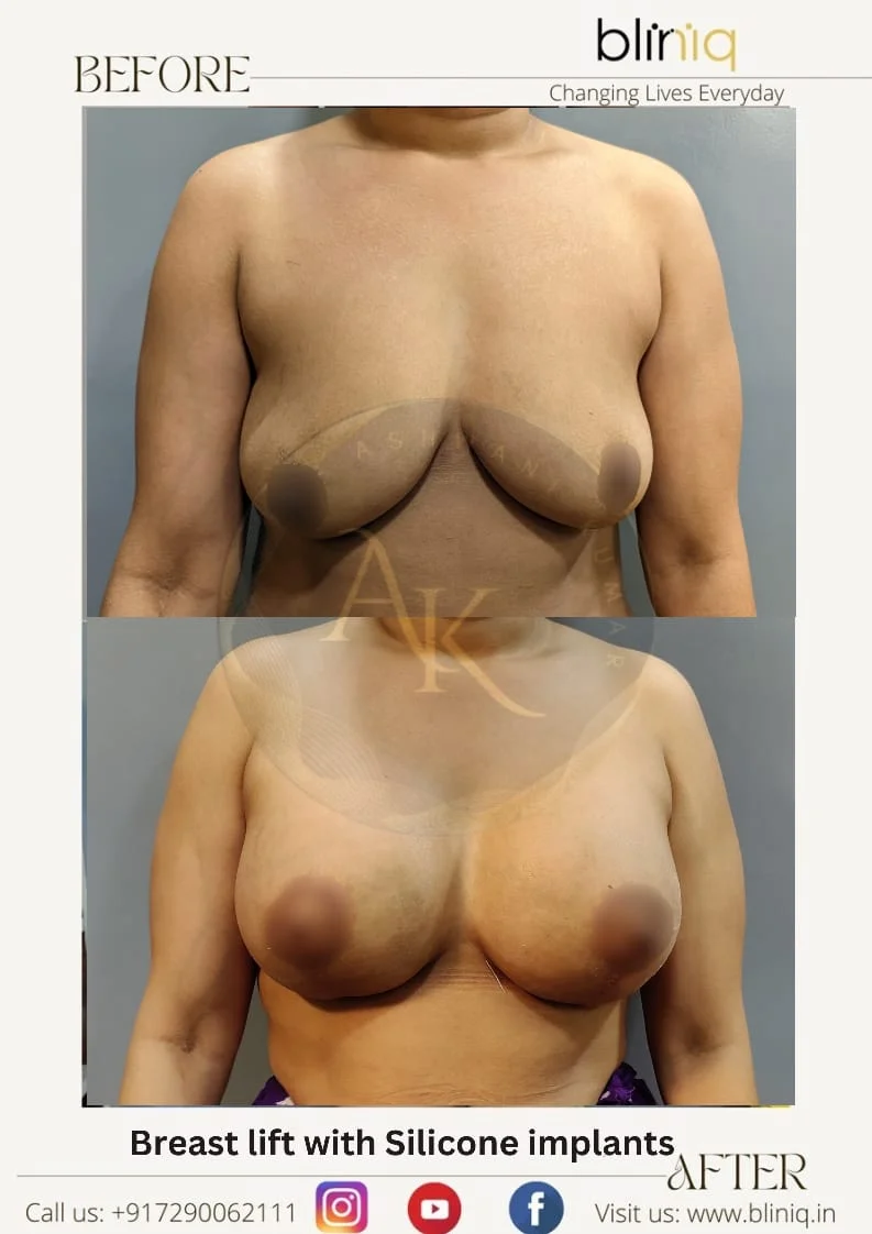 Breast Lift with Implants — Legacy Case 2