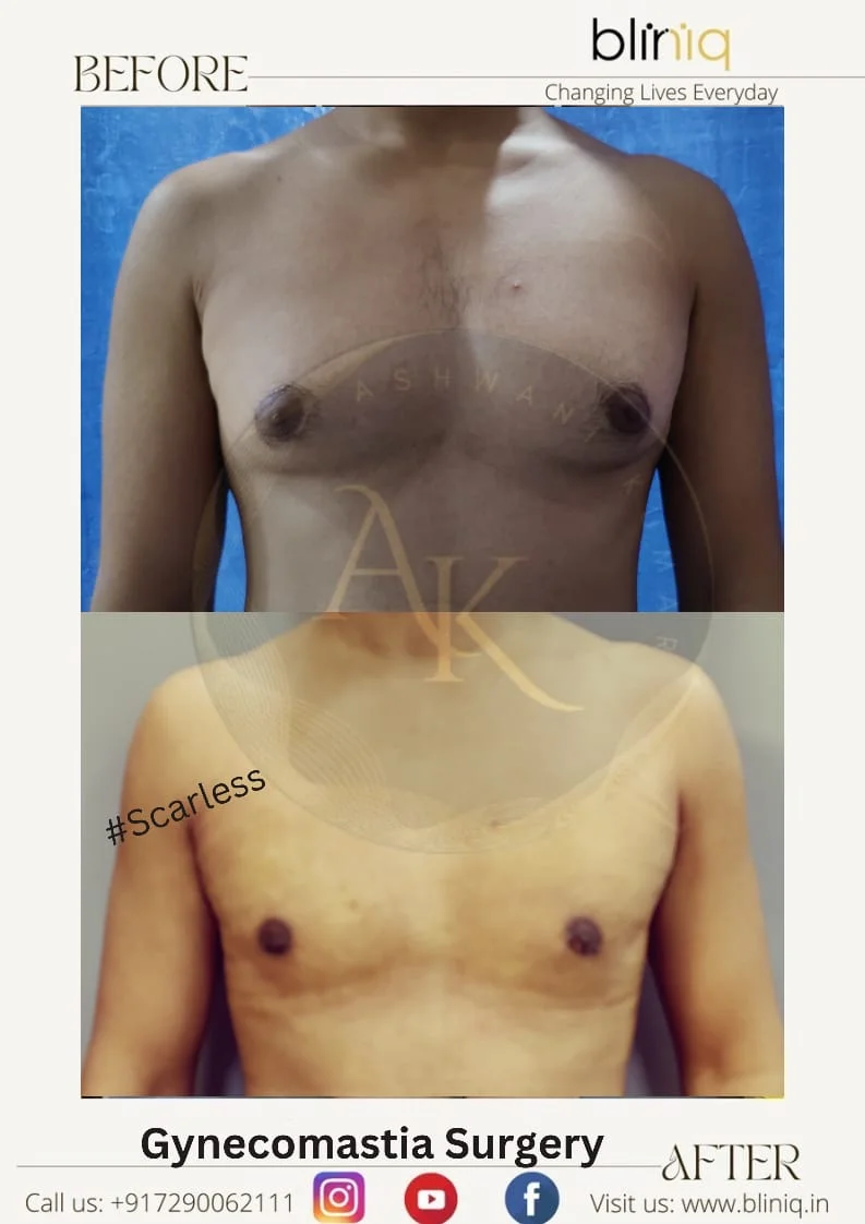 Gynecomastia Correction — Case 5
