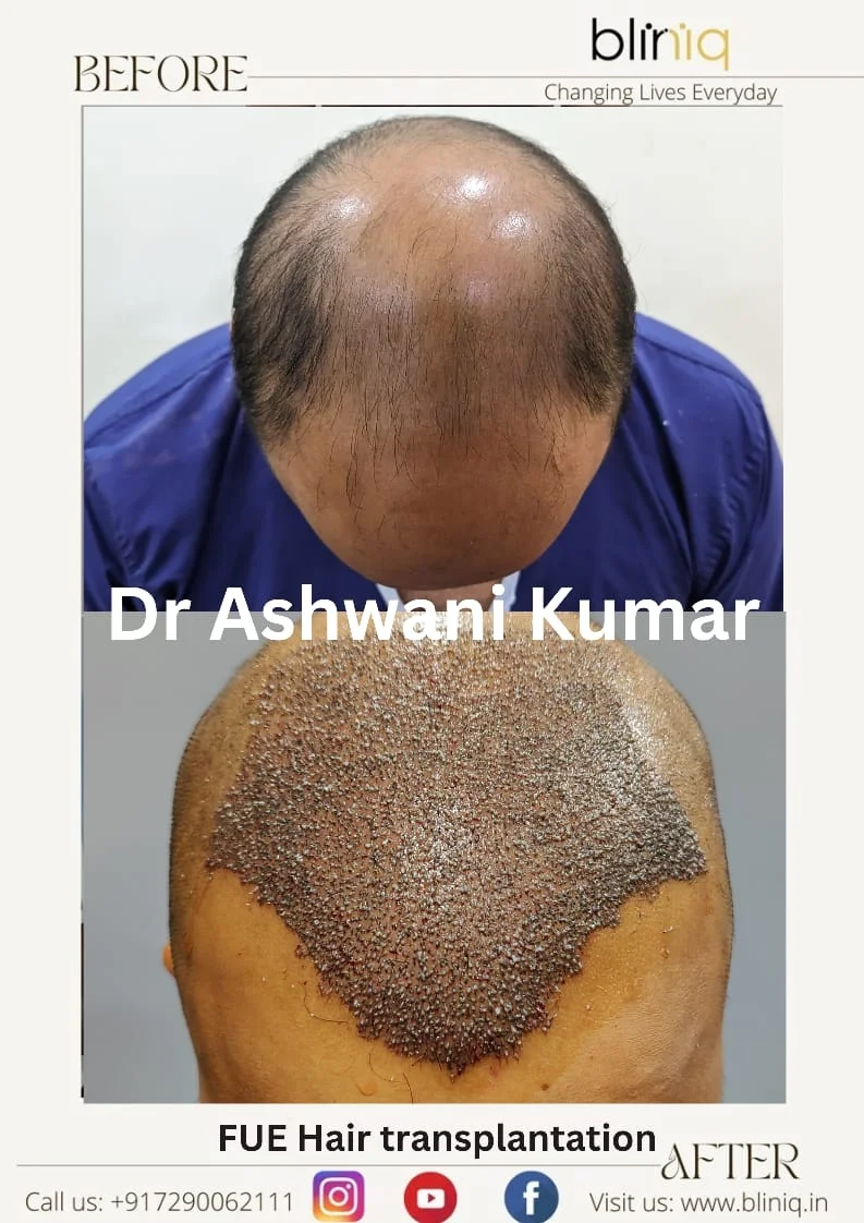Hair Transplant — Legacy Case 1