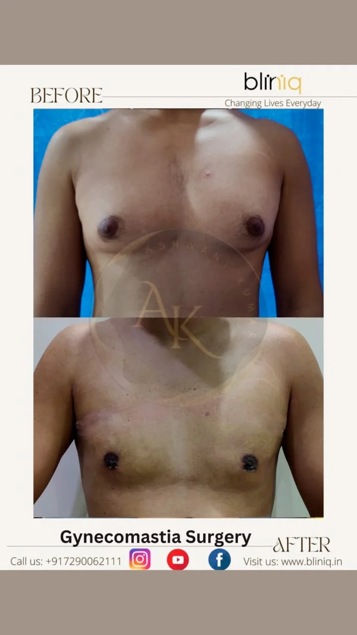Gynecomastia Correction — Case 7