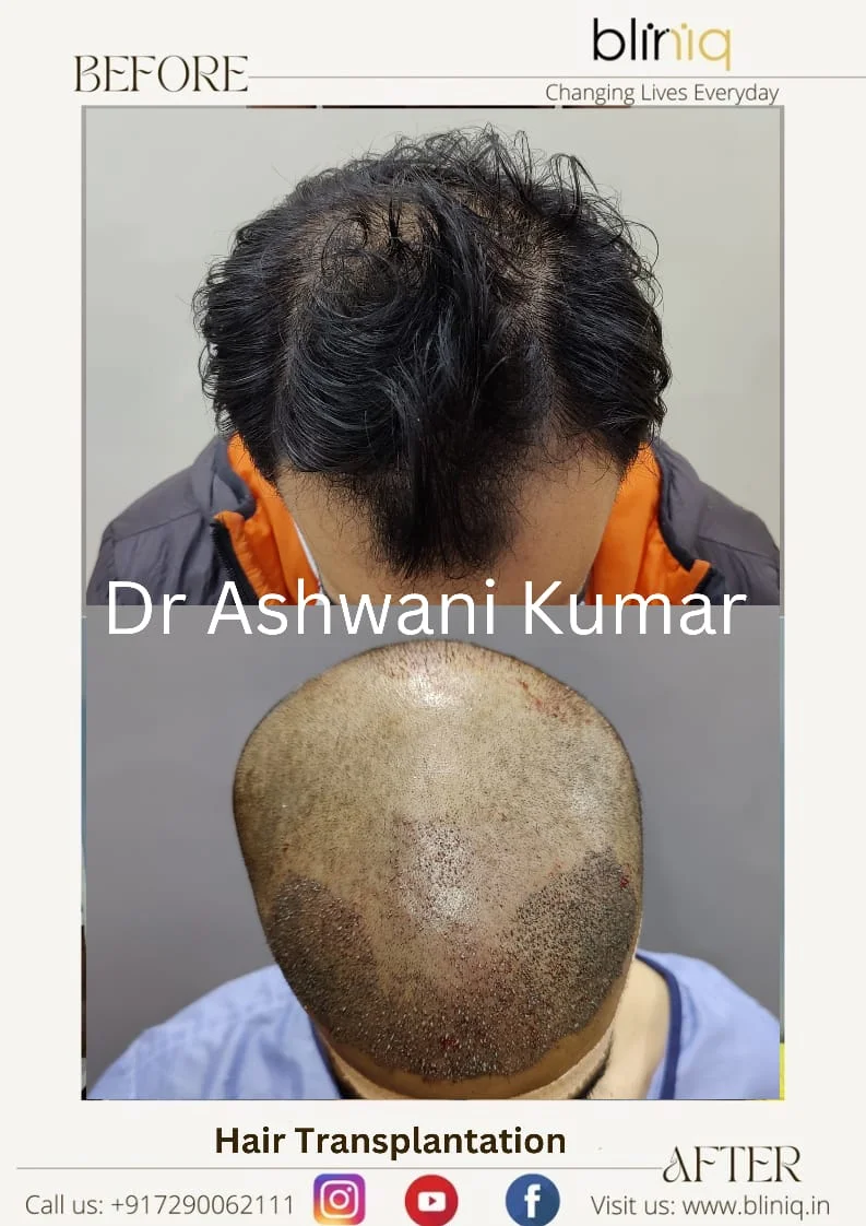 Hair Transplant — Legacy Case 3