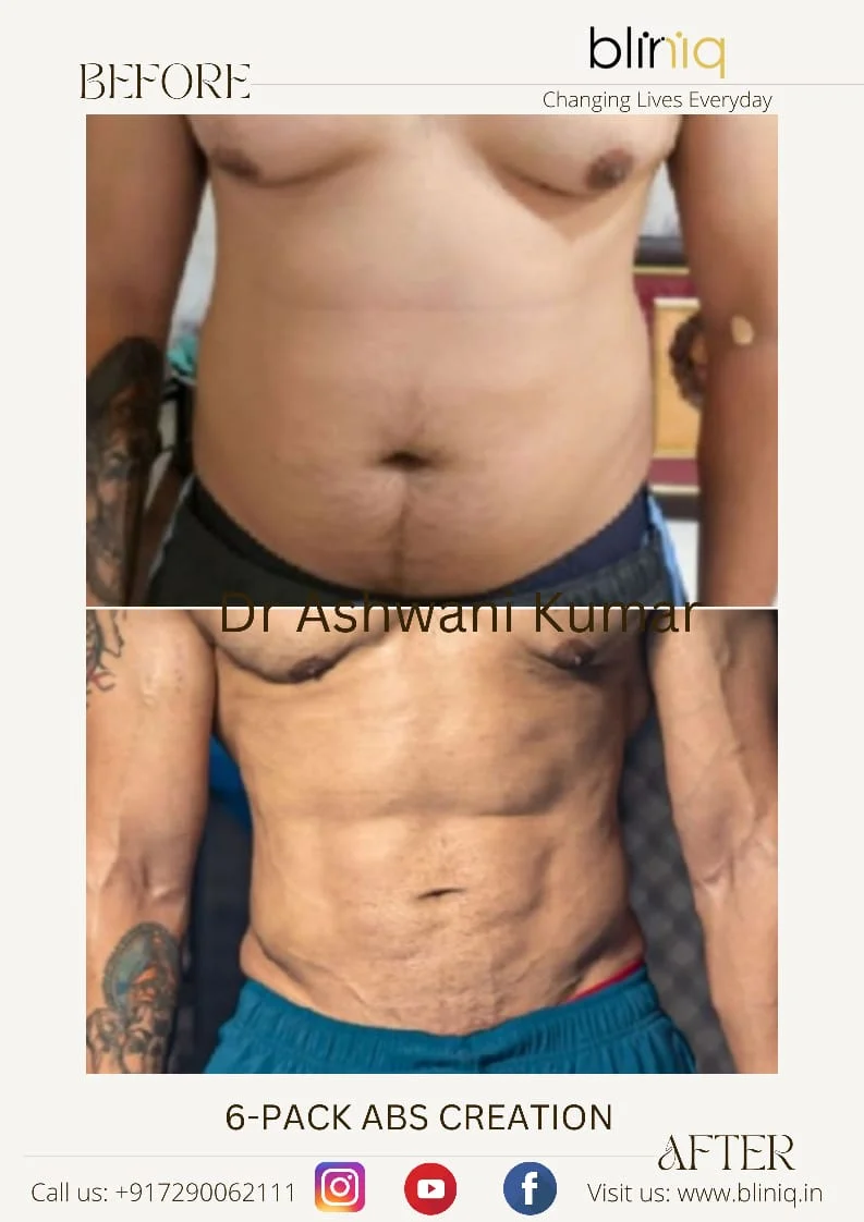 6-Pack Abs Creation — Case 1