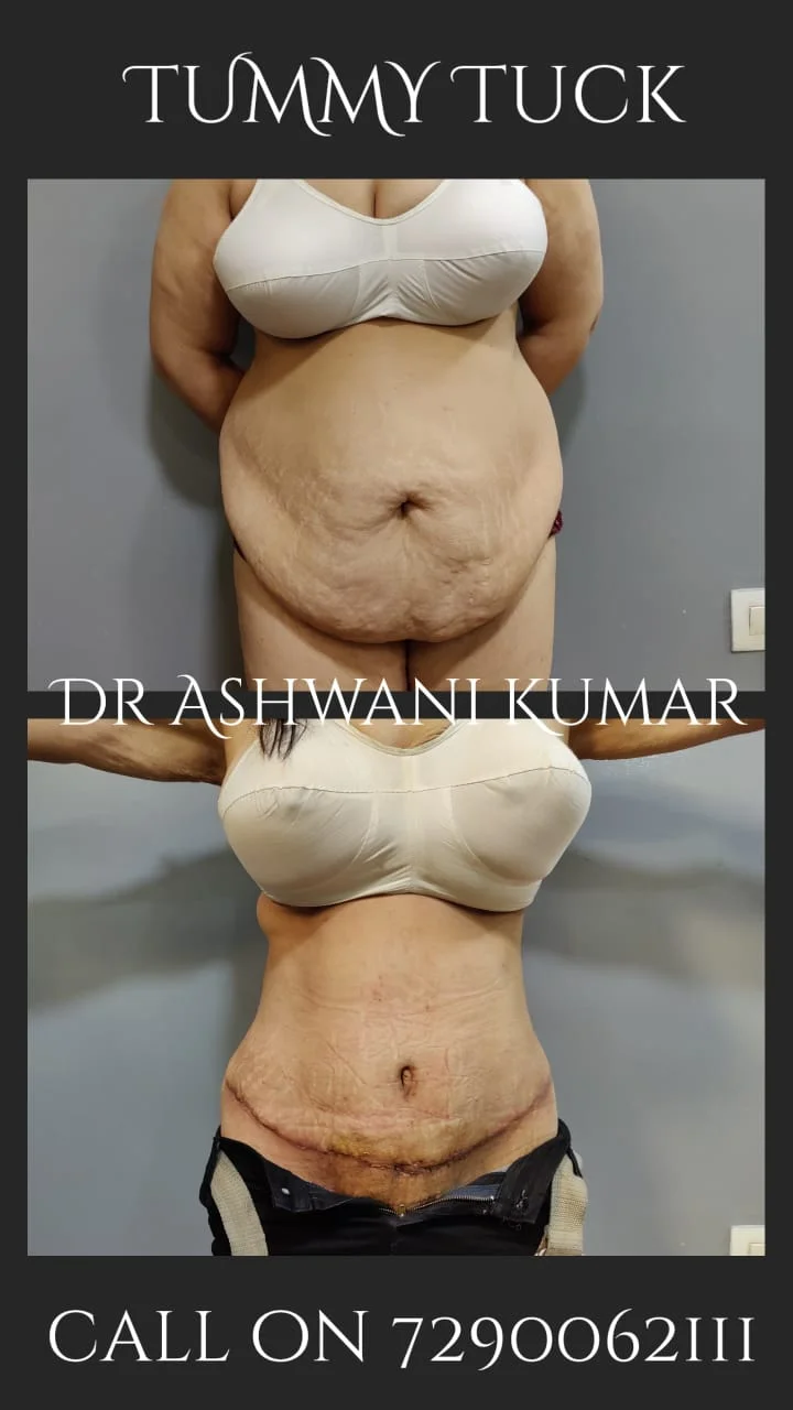 Tummy Tuck — Case 1