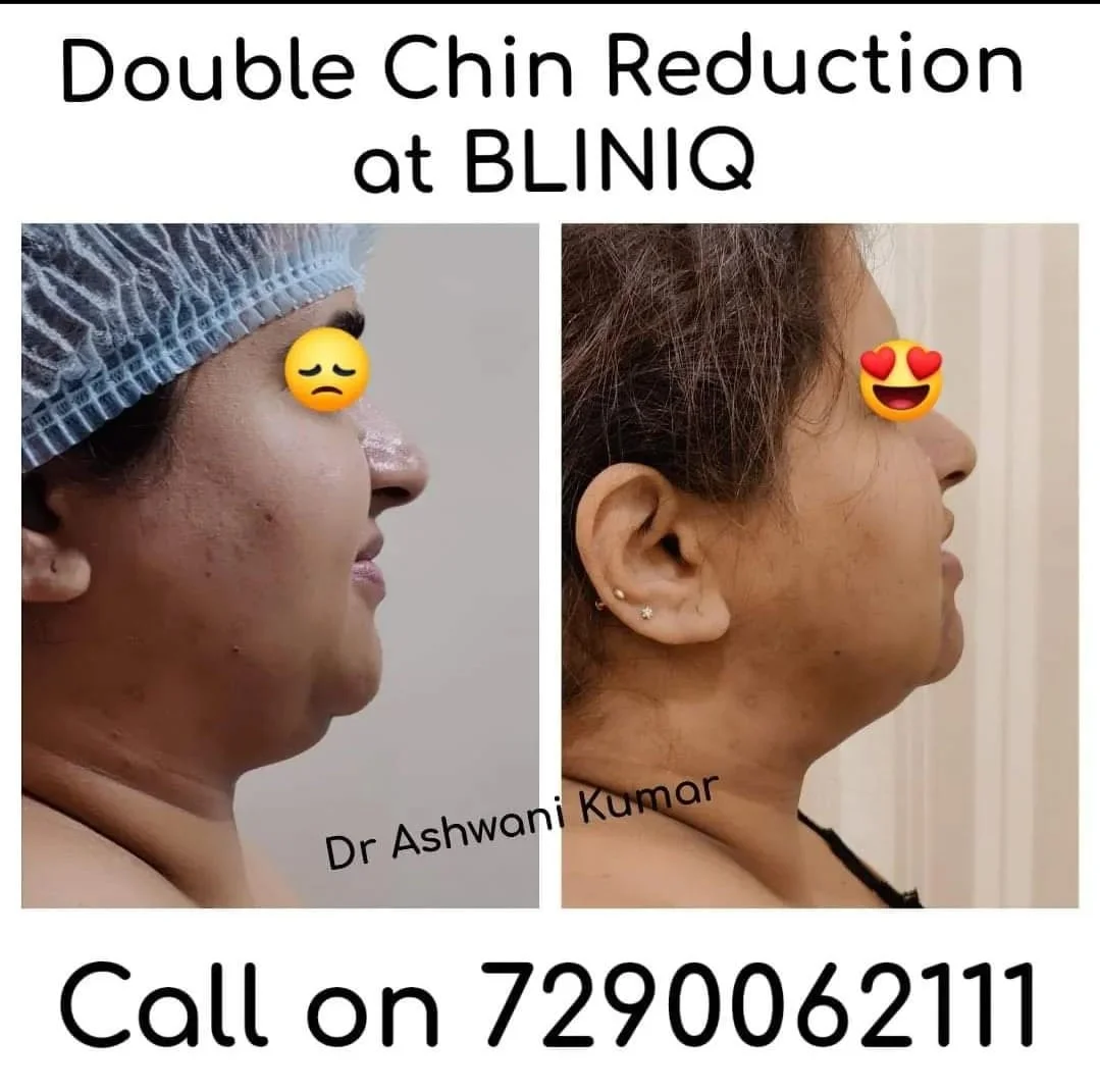 Gynecomastia Correction — Case 3