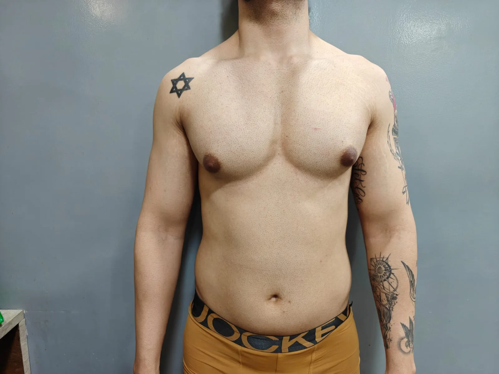 Gynecomastia Correction — Case 23