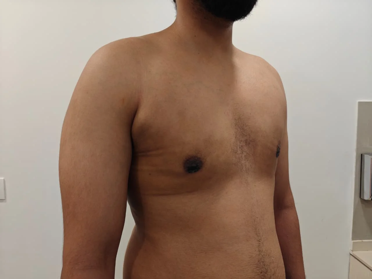 Gynecomastia — Case 2