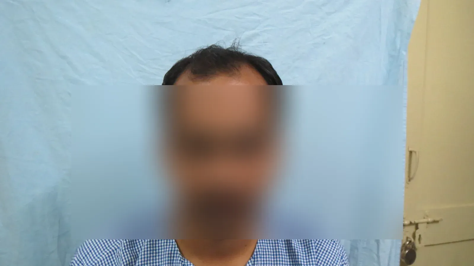 Hair Transplant — Case 1