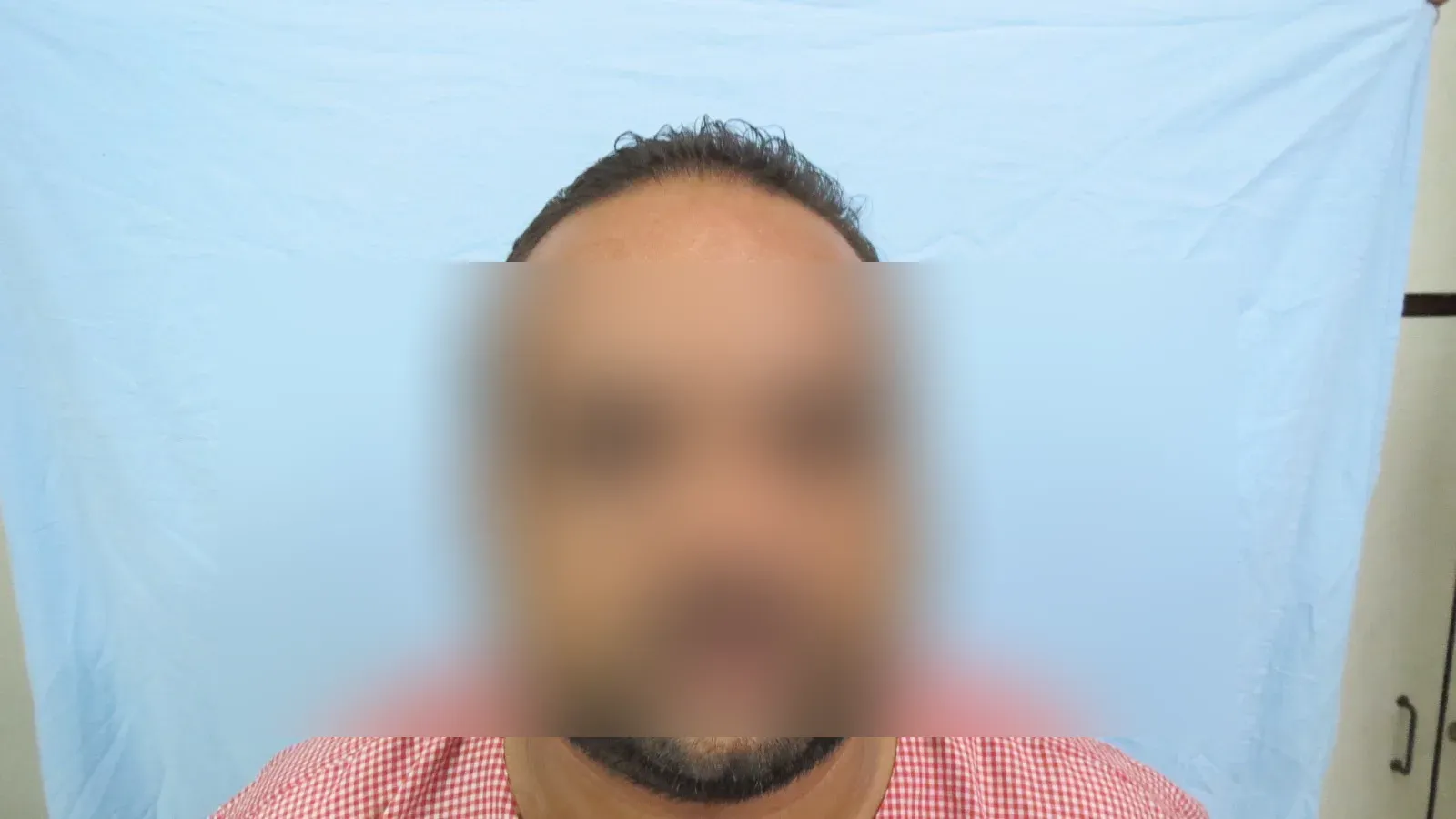 Hair Transplant — Case 2