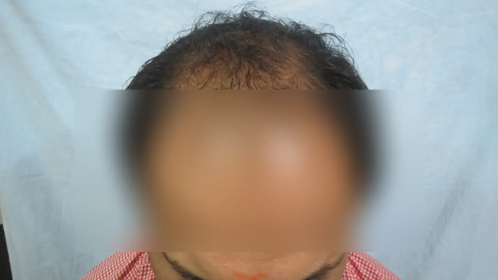 Hair Transplant — Case 3