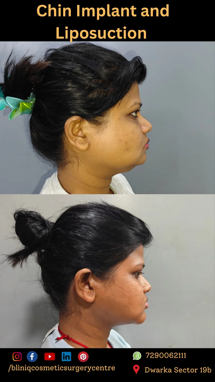 Liposuction — Case 1
