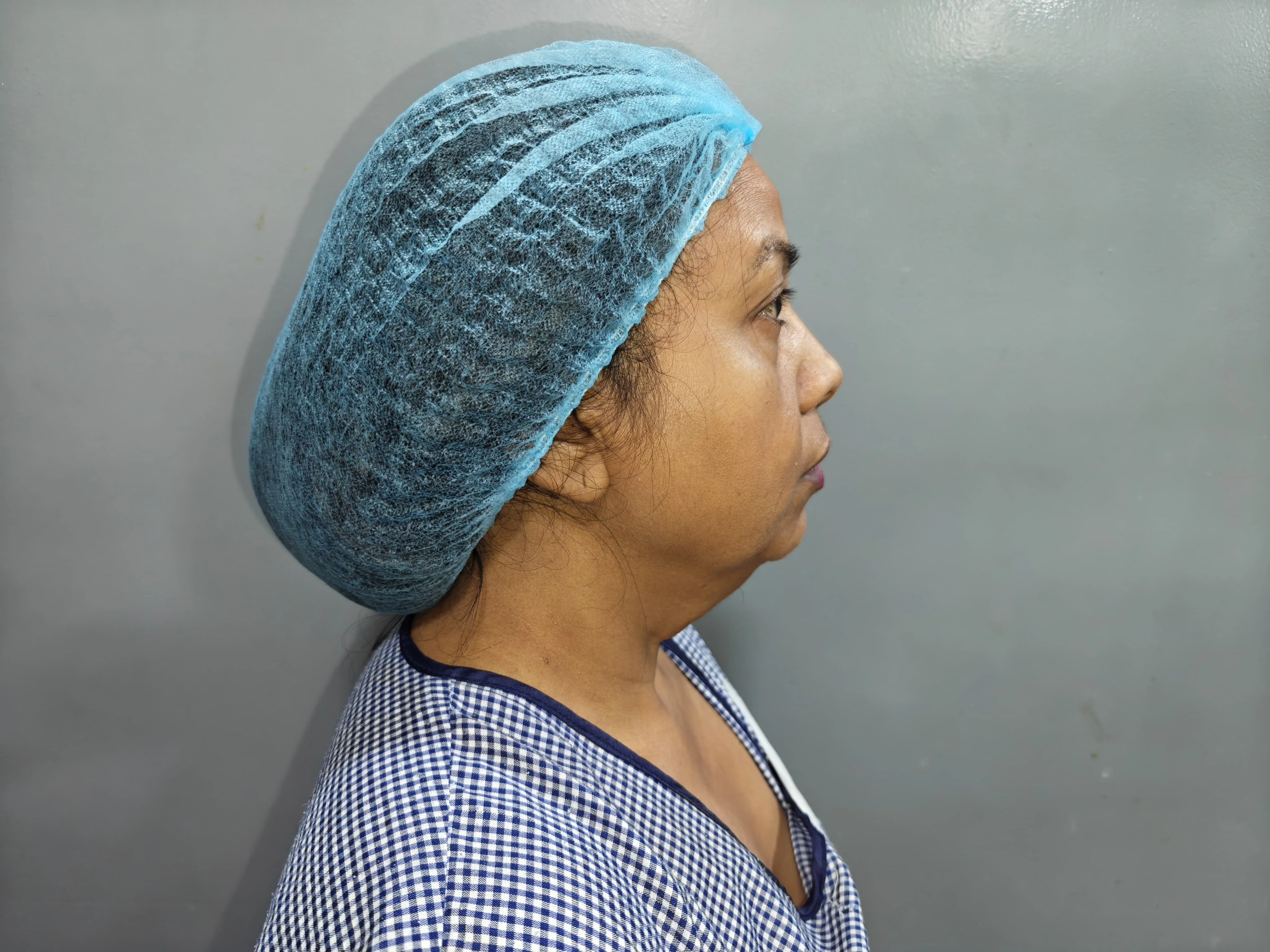 Neck Lift — Case 1