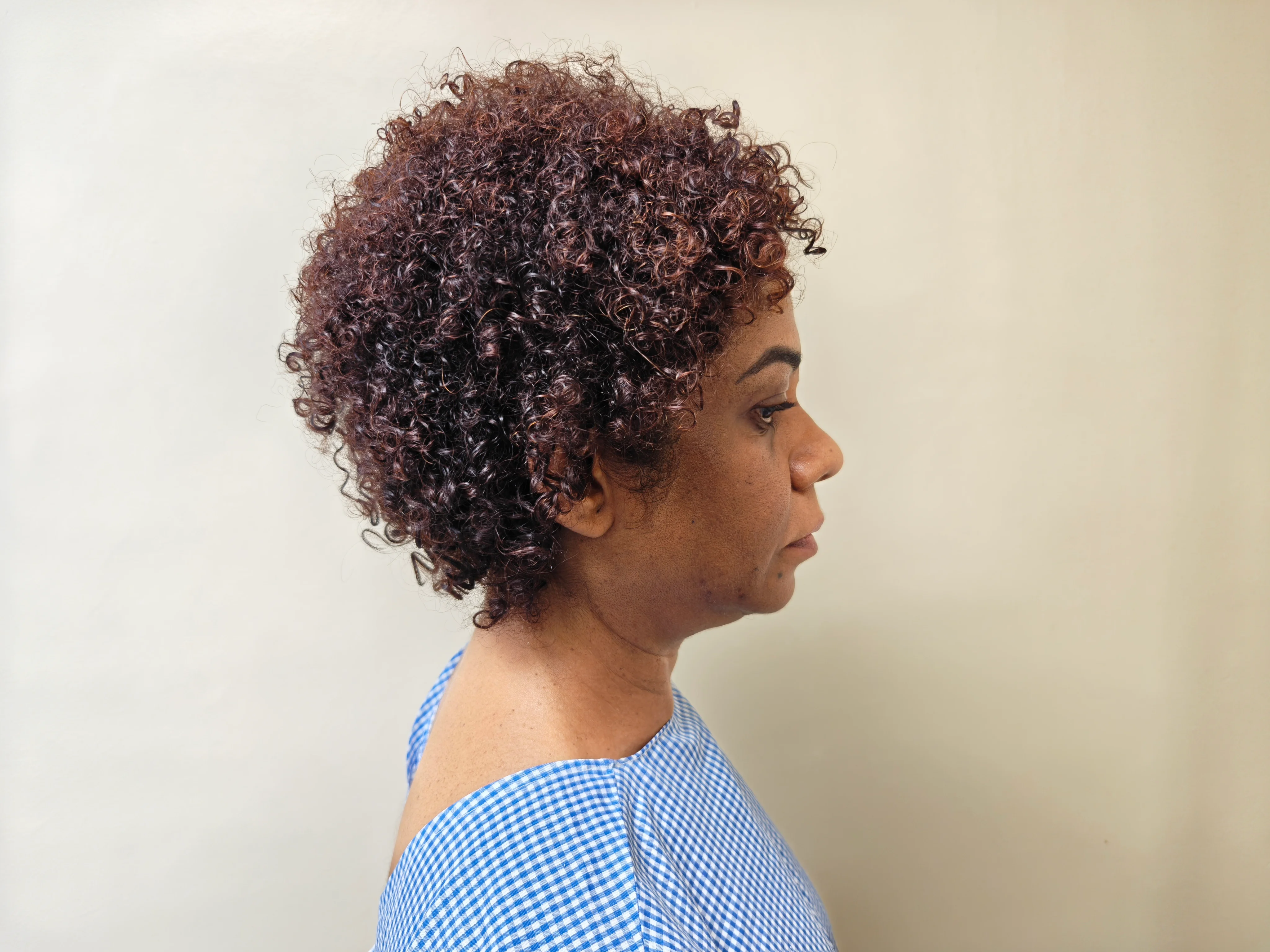 Neck Lift — Case 2