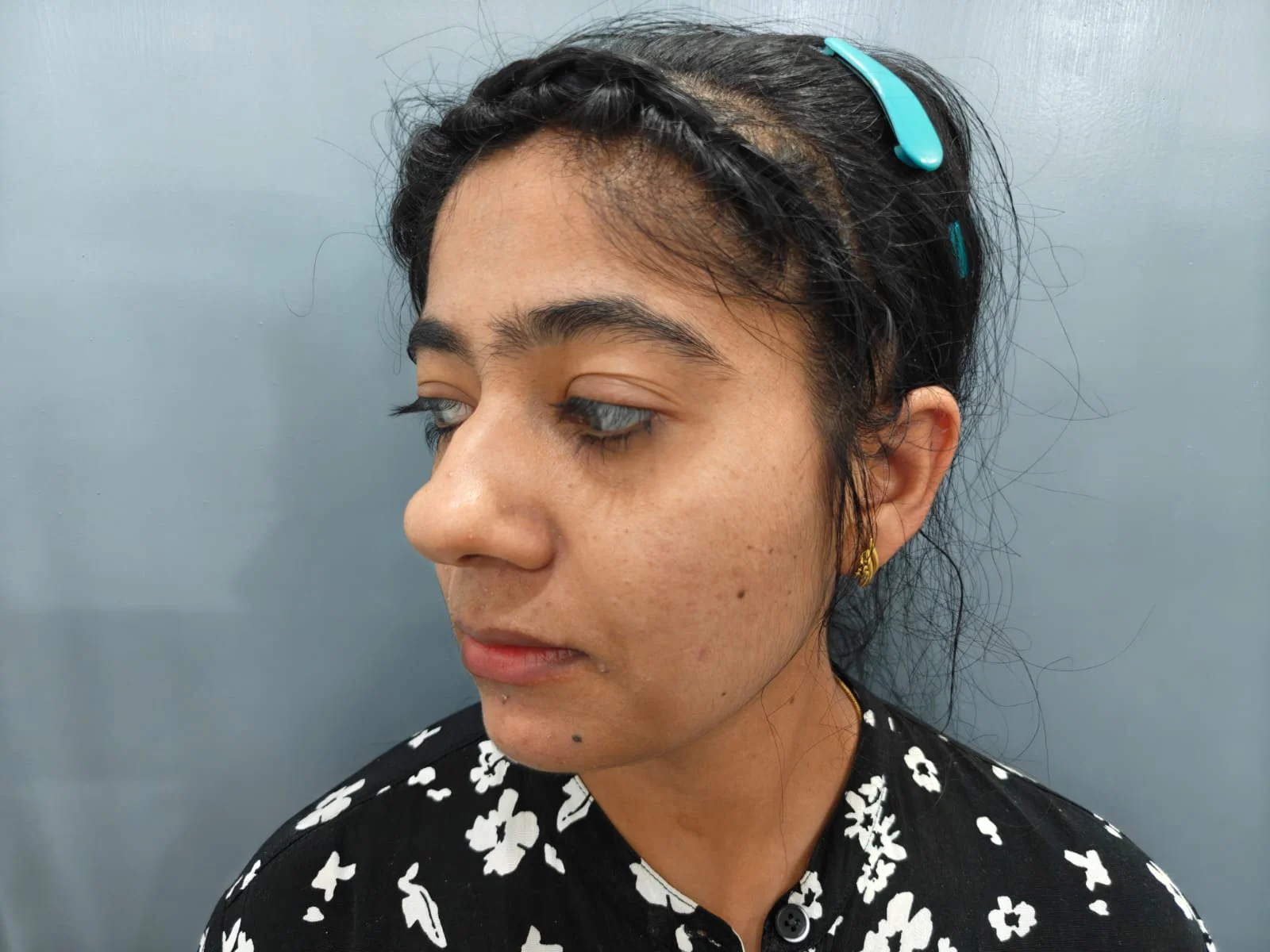 Rhinoplasty — Case 1