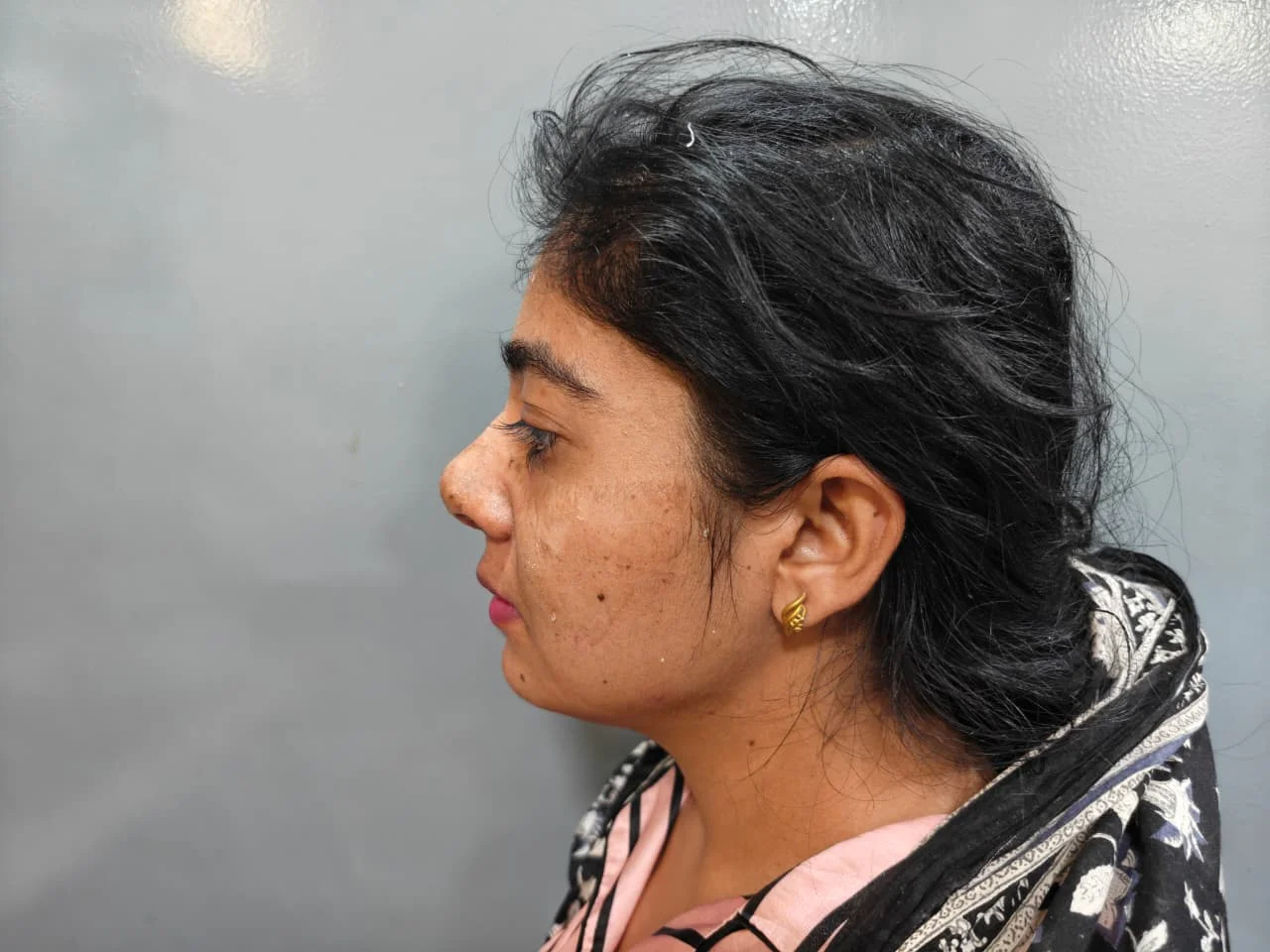 Rhinoplasty — Case 2