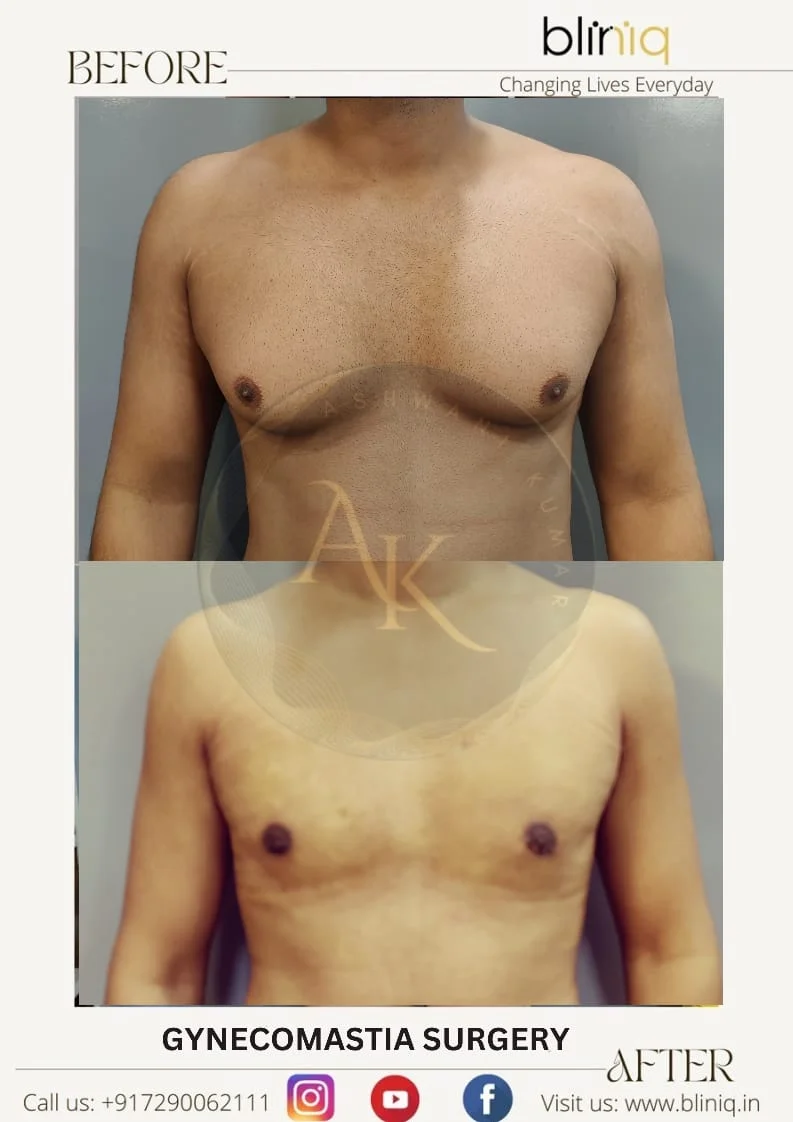 Gynecomastia Surgery (Male Chest Reduction)