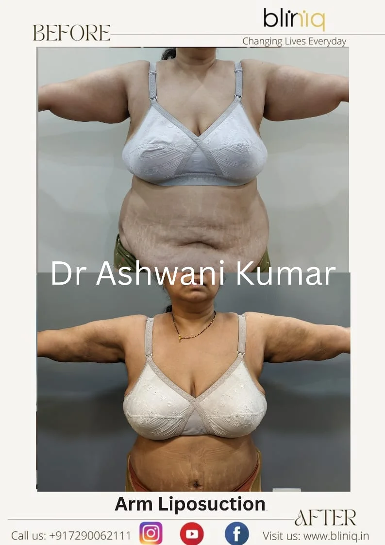 High-Definition 4D Body Contouring — Case 20