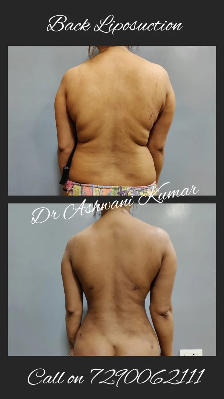 High-Definition 4D Body Contouring — Case 19