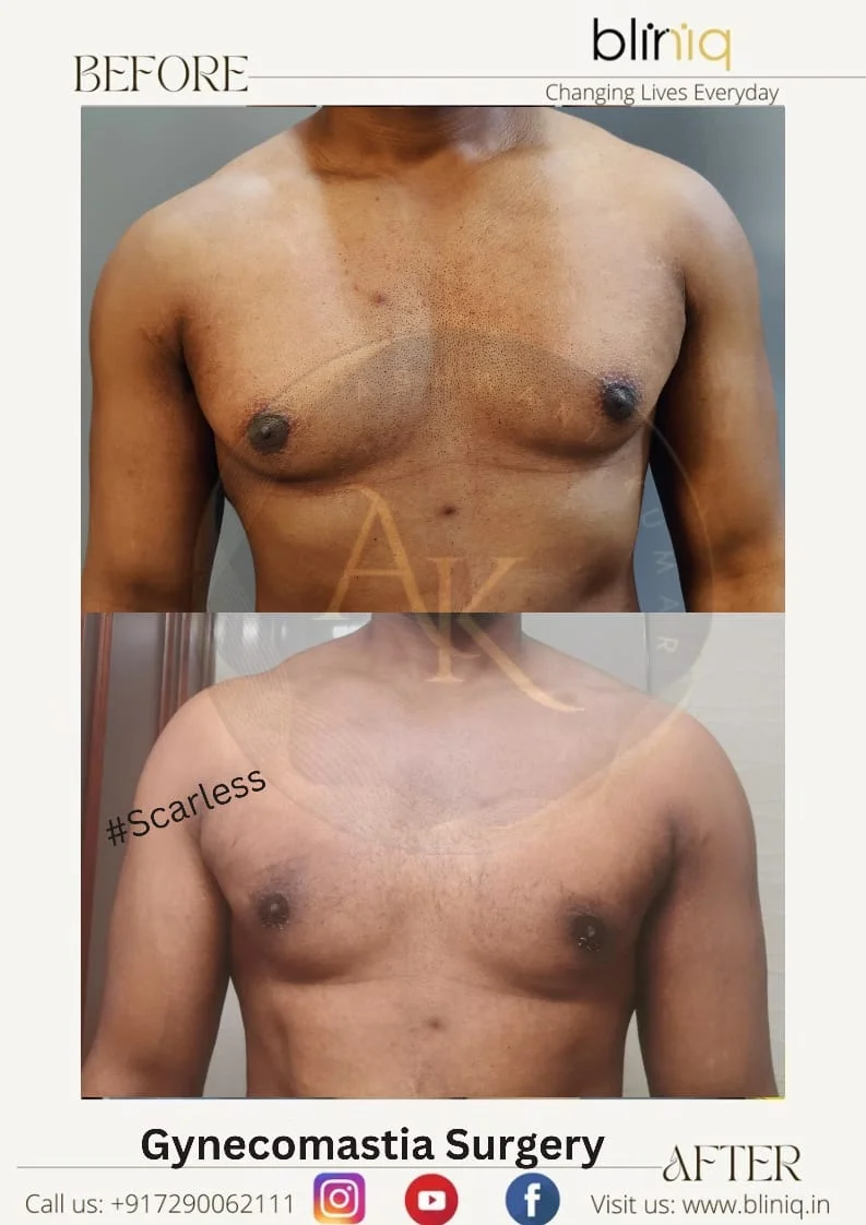 Gynecomastia Correction — Case 17
