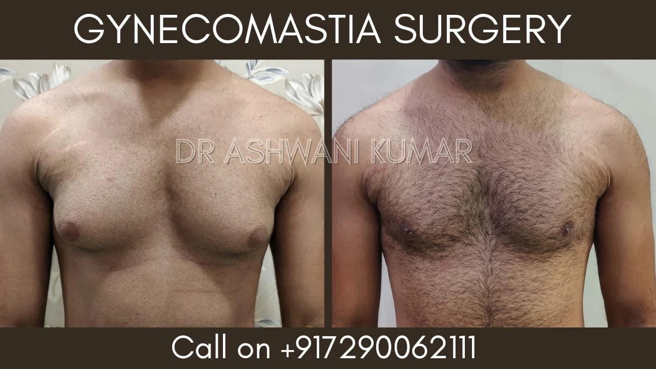 Gynecomastia Correction — Case 19