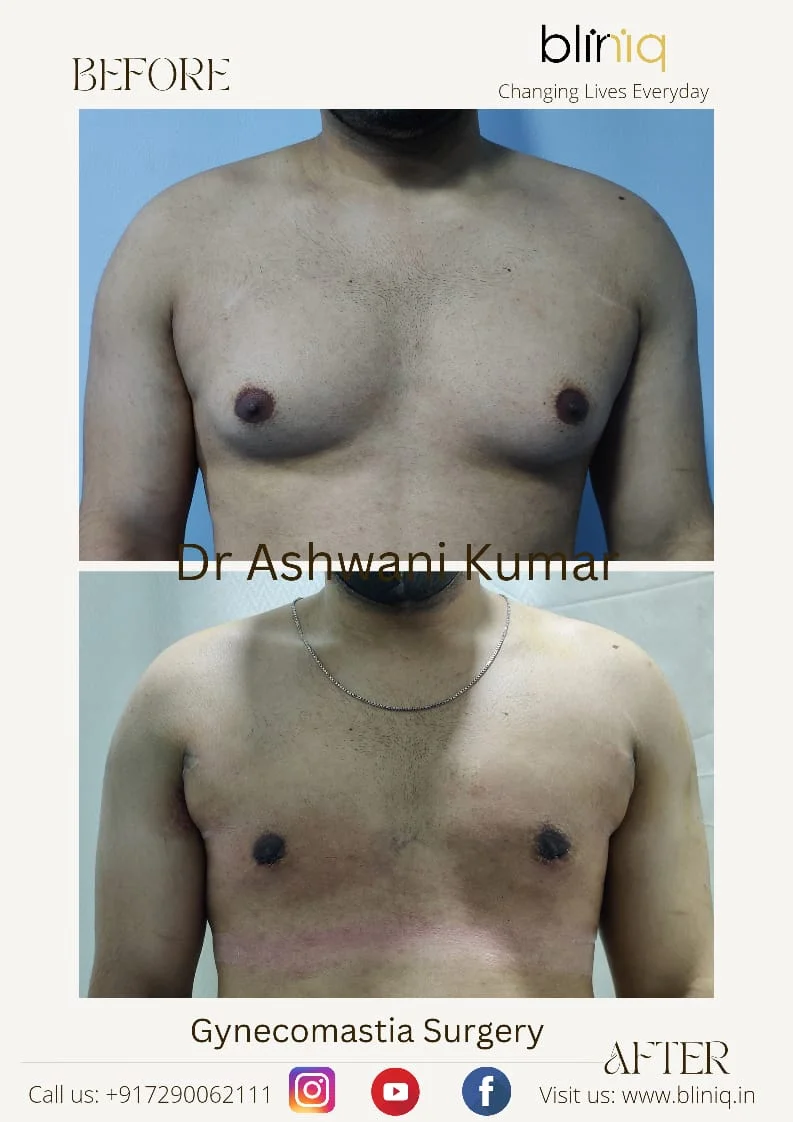 Gynecomastia Correction — Case 20