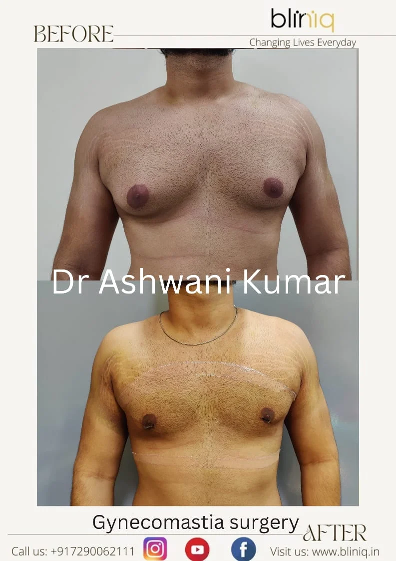 Gynecomastia Correction — Case 21