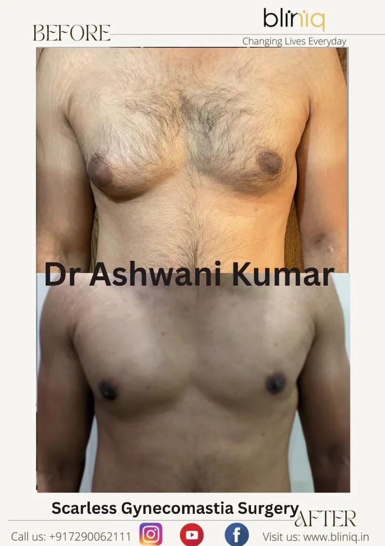 Gynecomastia Correction — Case 22