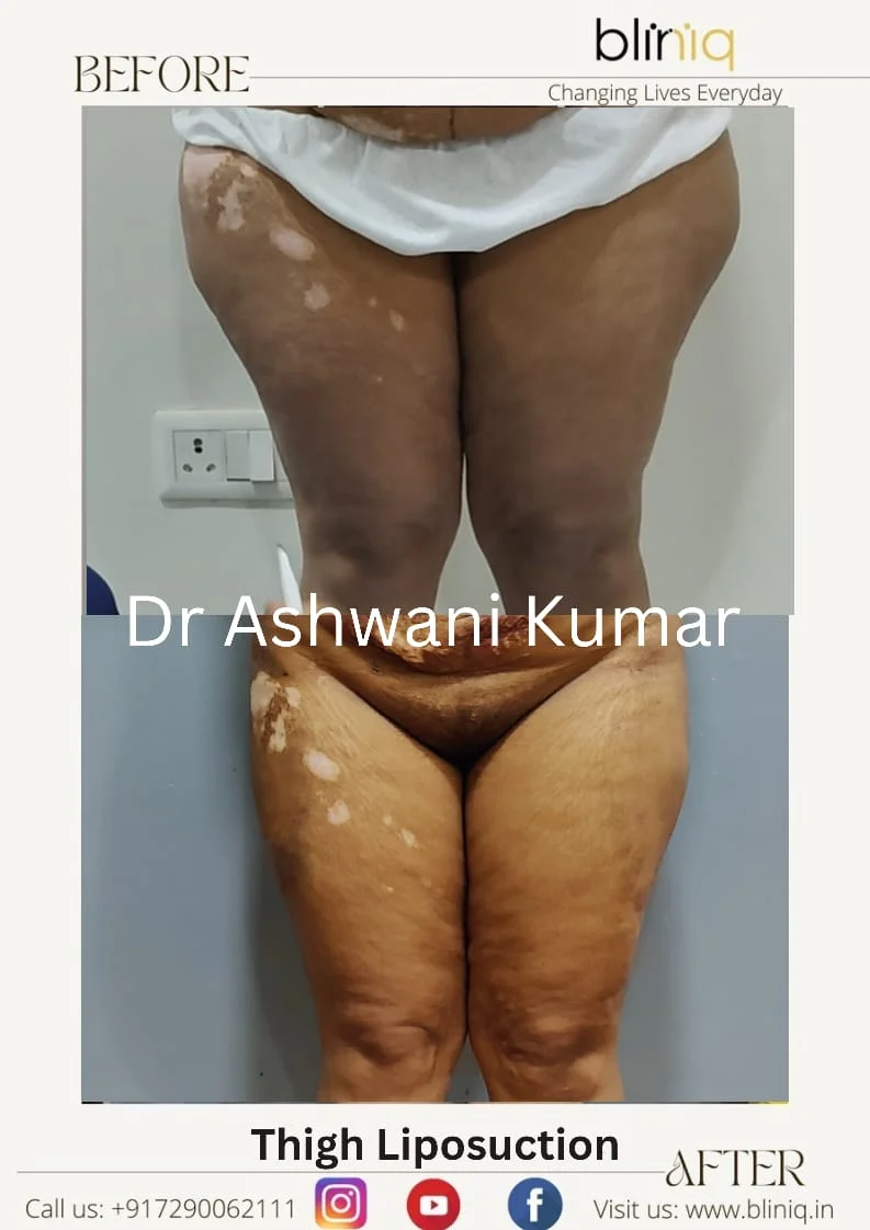 High-Definition 4D Body Contouring — Case 17