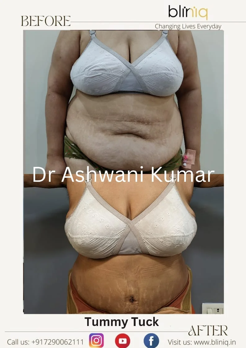Abdominoplasty Restoration — Case 15