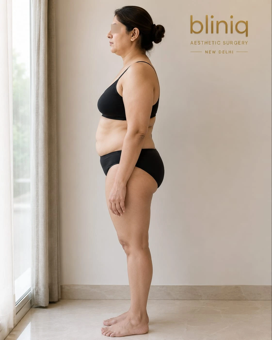 Abdominoplasty (Tummy Tuck)
